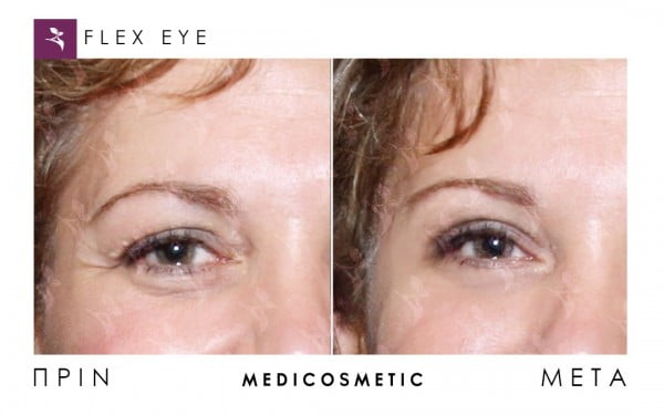 flexeye-before-after-3-600x375-1.jpg