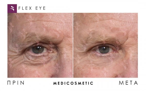 flexeye-before-after-4-600x375-1.jpg