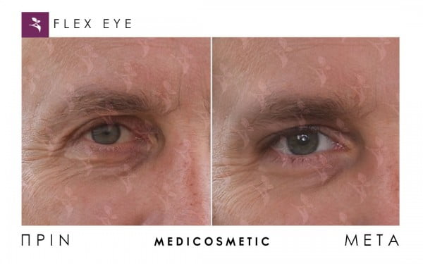 flexeye-before-after-5-600x375-1.jpg