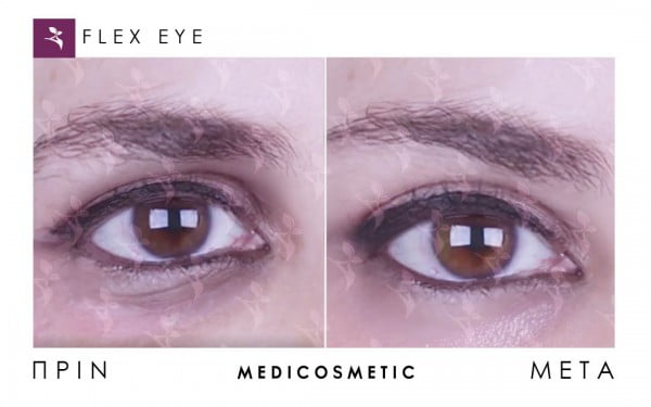 flexeye-before-after-600x375-1.jpg
